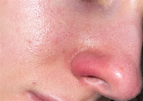 Inflamed Nostril