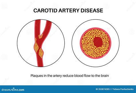 Carotid artery disease stock illustration. Illustration of stroke - 353874285
