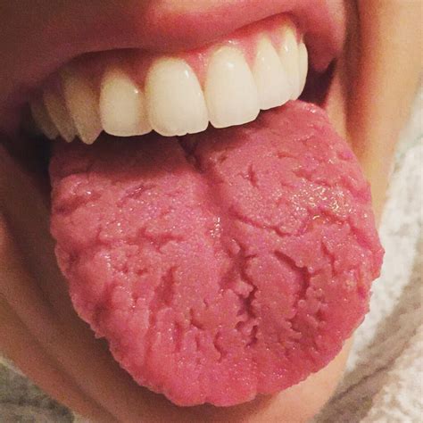 Cracked tongue: what it means, causes and simple explanations