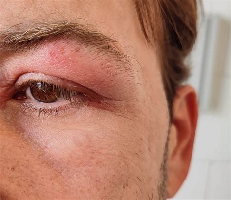 Eyelid Dermatitis Treatment Symptoms And Causes Eyelid Dermatitis