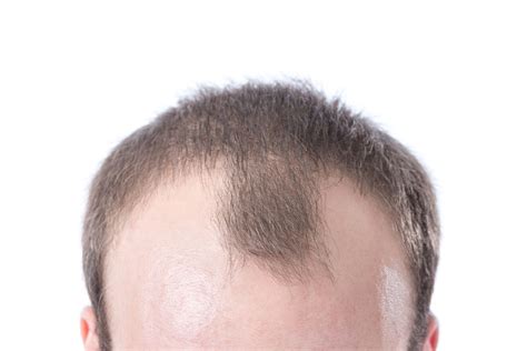 10 Ways To Deal With A Bad Receding Hairline - Wimpole Clinic