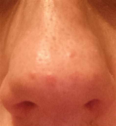 Permanent red spots on nose : r/AusSkincare
