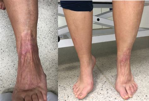 Aggressive Necrotizing Fasciitis in a 12-Year-Old Girl of Unknown ...
