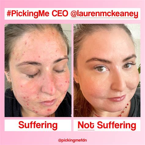 Dermatillomania aka Skin Picking Disorder/ Excoriation/ Excoriation ...