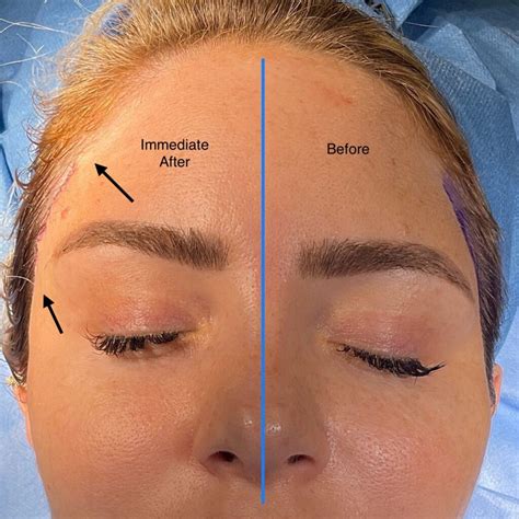 Lateral Temporal Brow Lift by Olivier Amar - London