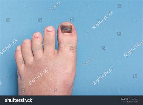 Injury Nail Big Toe Hematoma Bruising Stock Photo (Edit Now) 2126647643