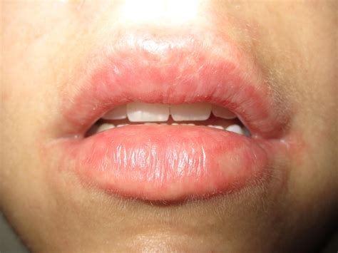 Lips Allergic Reaction Causes at Alonzo Christensen blog