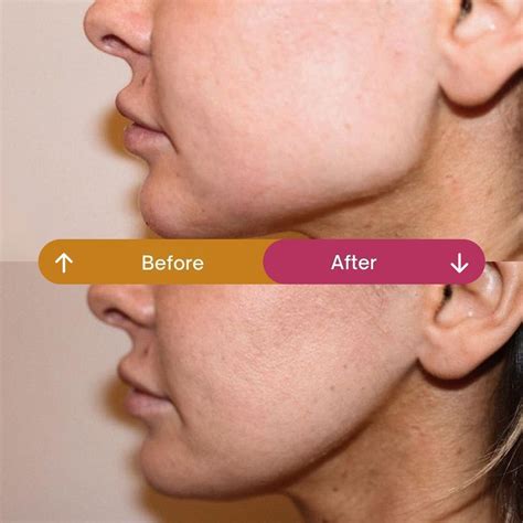 Masseter Botox: How Long It Lasts & What to Expect - how long until botox kicks in