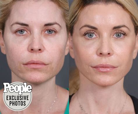 Botox Face Lift