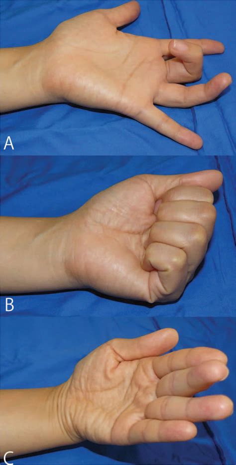 Turnbuckle Splint For Volkmann Ischemic Contracture at Tomas Jacobs blog