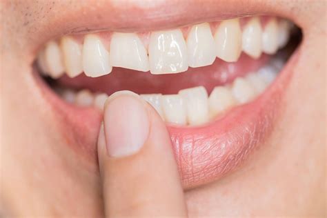 Porcelain Crowns Front Teeth