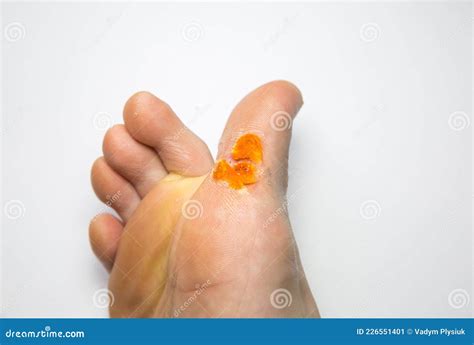 Contagious Skin Illness on Foot. Medical Treatment Photo..Close Up Photo of Plantar Wart on Man ...