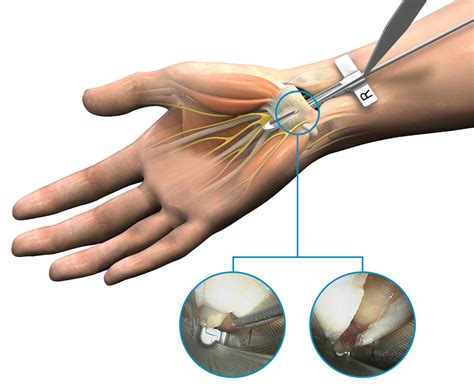 Endoscopic carpal tunnel release - TXOSA