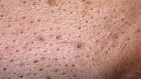 Extreme pimple popping with the ugliest blackheads in history