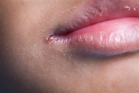 Corner Of Mouth Pimple Or Cold Sore at Sarah Hudson blog