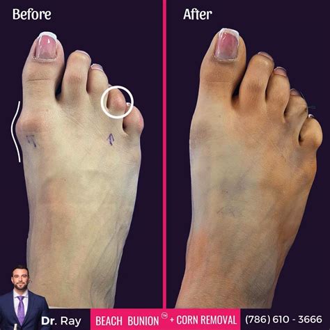 What to Know About Corn Removal Surgery Before And After