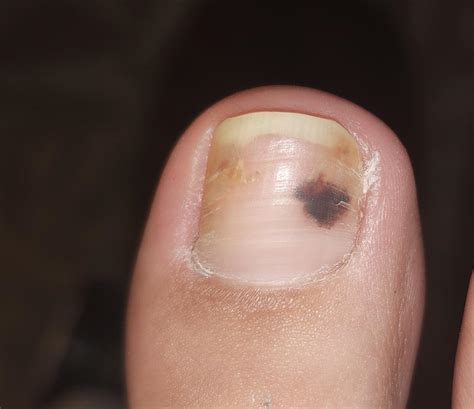 is this fungus or a bruise? : r/NailFungus