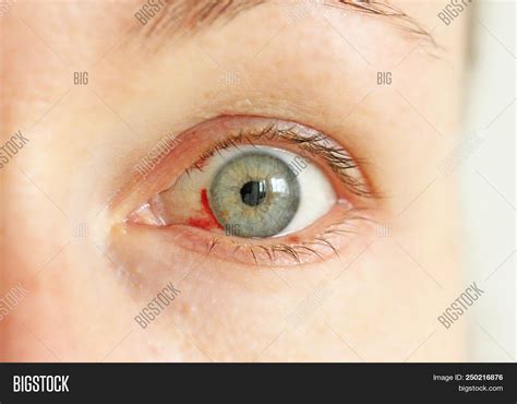 Bloodshot Eye. Woman With Burst Blood Vessel In Eye. Very Red Bloody Eyeball. Bleeding Damage In ...