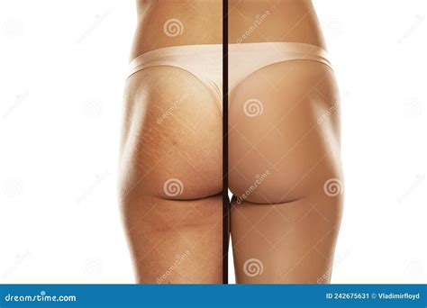 Comparison before and after Woman Buttocks with Stretch Marks Removal Treatment Stock Image ...