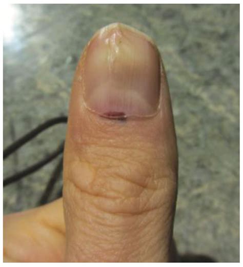 Melanoma On Finger