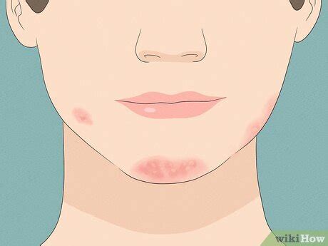 Beard Burn: How to Stop Rashes & Breakouts from Kissing