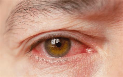 10 Symptoms of Blepharitis (Eyelid Inflammation) You Shouldn't Ignore