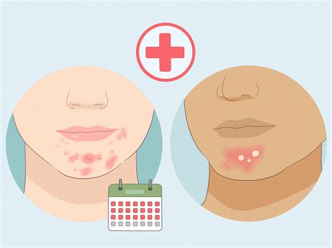 Beard Burn: How to Stop Rashes & Breakouts from Kissing