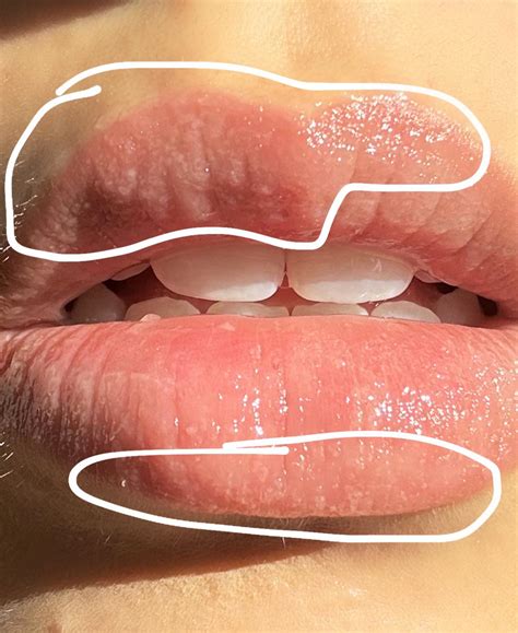 Itchy lip bumps-oozing clear fluid, not cold sores. HELP!! : r/Accutane