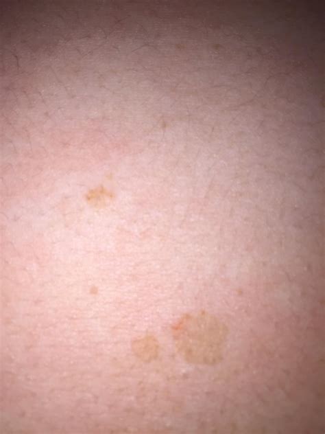 Spots On Skin Skin Lesions: Pictures, Types, Causes, Treatment