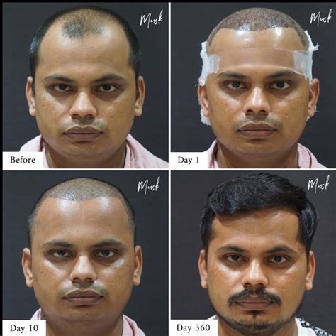Hair Transplant After 3 Months: Results, Growth Timeline and Photos