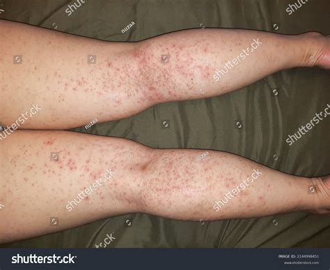 Pimples On Thighs