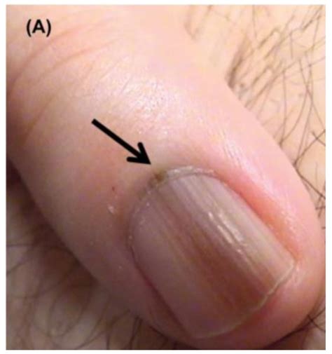Adult and Pediatric Nail Unit Melanoma: Epidemiology, Diagnosis, and Treatment
