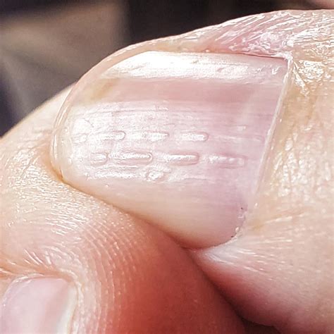 Ridges In Nails Thyroid