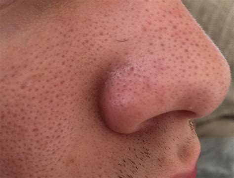 Get Rid Clogged Pores on Nose, Squeeze, Clean, Remedies, Causes of Large Nose pores - American ...