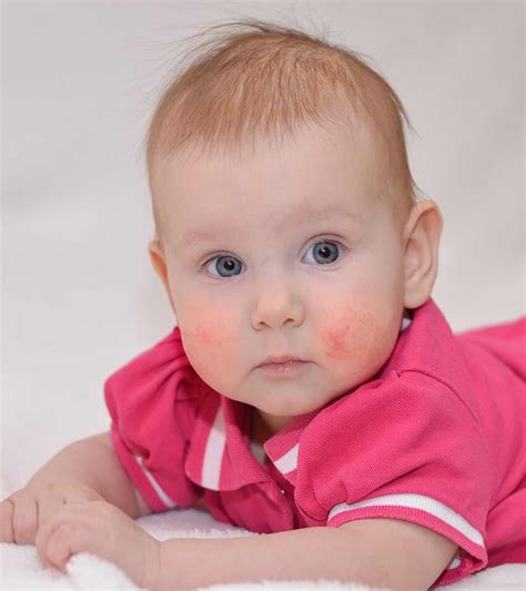 Dairy Allergy Rash Adults