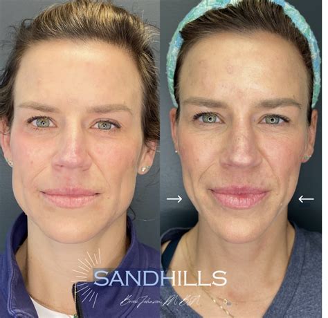 Masseter Slimming with Botox | Sandhills Oral & Facial Surgery