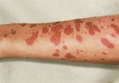 Steven Johnson Syndrome Philadelphia Stevens Johnson Syndrome (SJS)