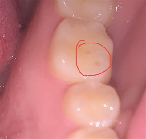 what are these small, circular holes in my molars? : r/askdentists