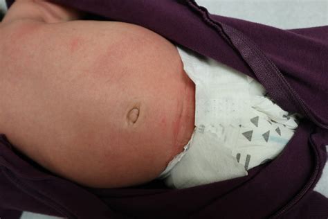 Abnormal “bruising” over the abdomen of a neonate - Rahman - 2024 ...