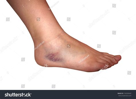 1,268 Bruised ankle Images, Stock Photos & Vectors | Shutterstock
