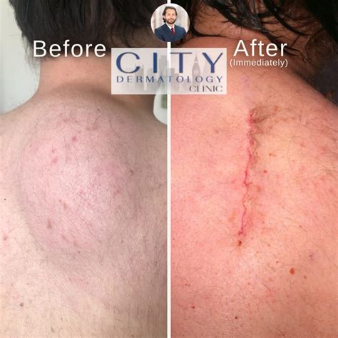 Before and After Lipoma Removal Results