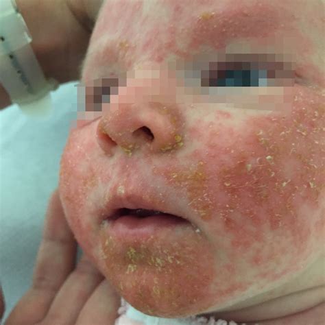 Eritema Tóxico Neonatal