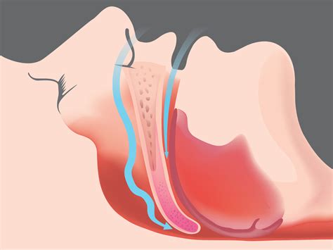 Wheezing When Lying Down