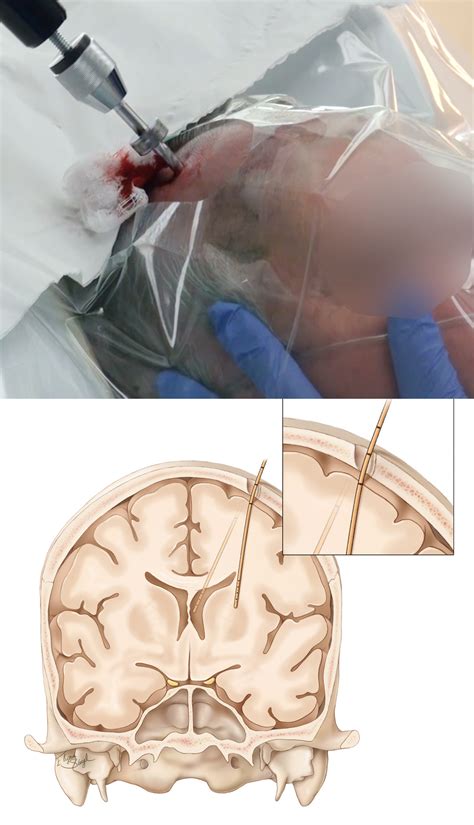 External Ventricular Drain | The Neurosurgical Atlas