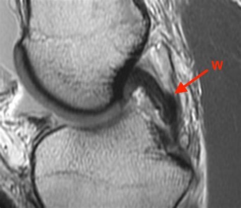 Bucket-handle Tear of the Meniscus - Radsource