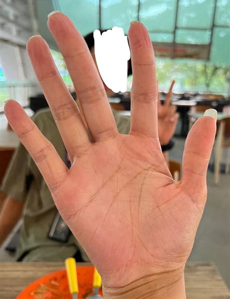 Magnesium has helped my dyshidrosis TREMENDOUSLY! : r/Dyshidrosis