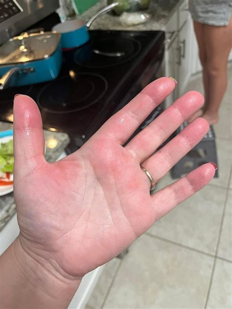 Cold urticaria : r/urticaria