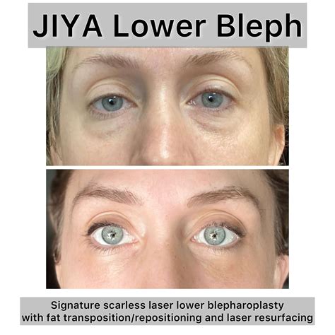 Lower Blepharoplasty Raleigh, NC | Raleigh Eye Lift