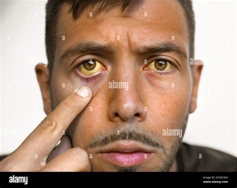 Liver disease yellow eyes skin hi-res stock photography and images - Alamy
