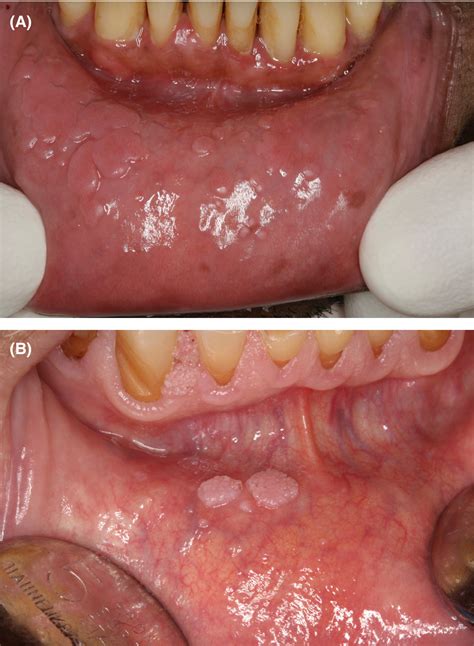 Intraoral Herpes Gums